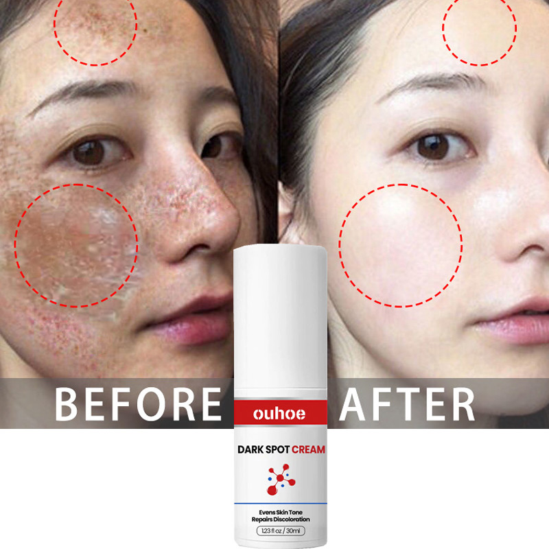 Powerful Whitening Freckle Cream Dark Spot Remover Melasma Fade Melanin Pigmentation Improve Dull Brighten Skin Care Products