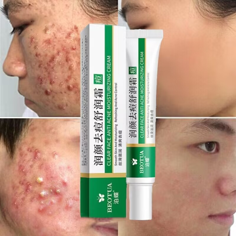 Herbal Acne Treatment Face Cream Removal Pimples Scars Blackhead Shrink Pores Oil Control Gel Moisturizing Whitening Skin Care