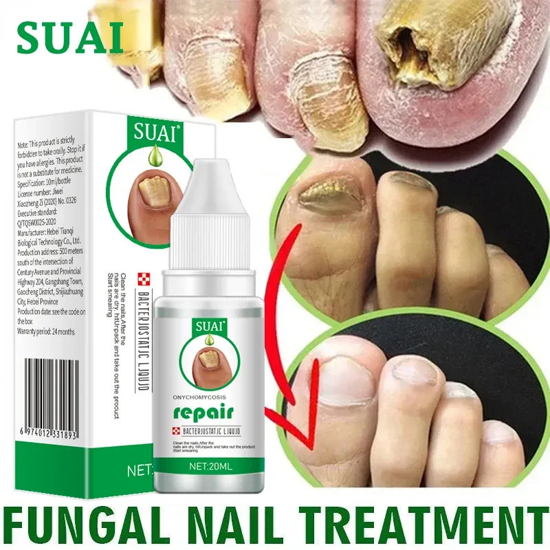 Nail Fungal Treatment Serum Onychomycosis Paronychia Anti Infection Hand Foot Removal Repair Damaged Nail Essence Gel Feet Care