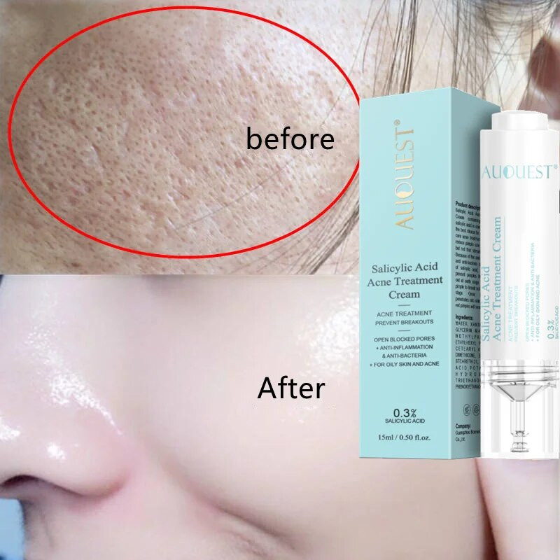 Salicylic Acid Acne Treatment Cream Anti-acne Gel Shrink Pores Oil Control Blackheads Moisturizing Brighten Skin Care Products