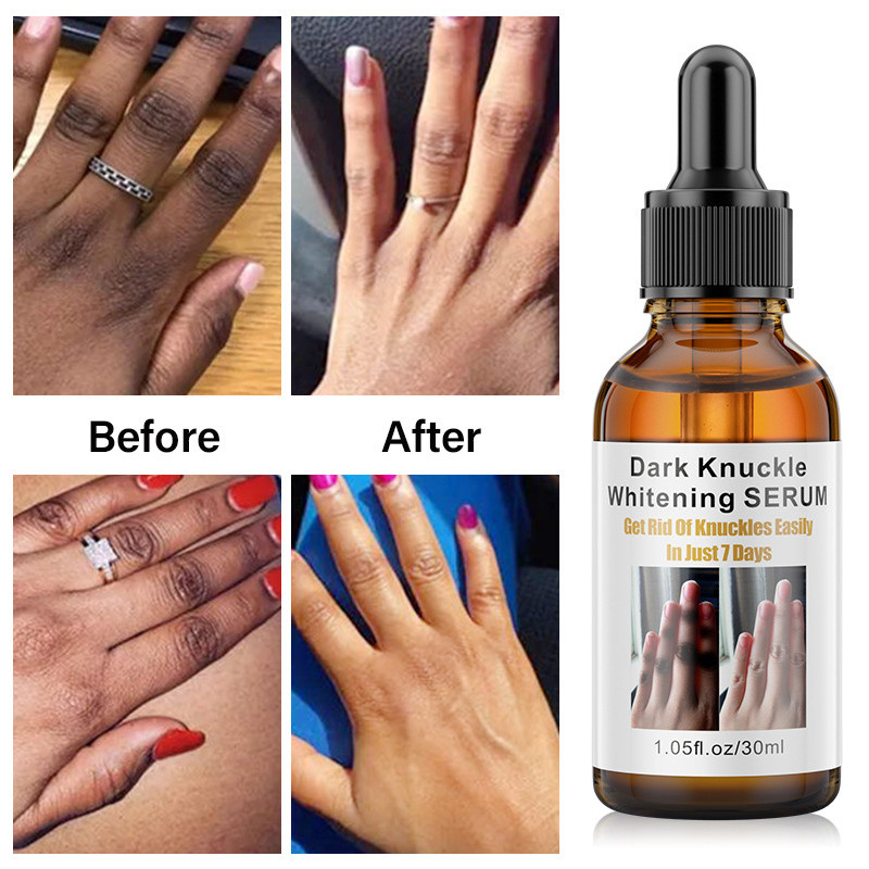 Fast Dark Knuckles Whitening Serum Hand Knuckle Elbow Knee Bleach Pigmentation Corrector for Black Skin Essence Beauty Body Care