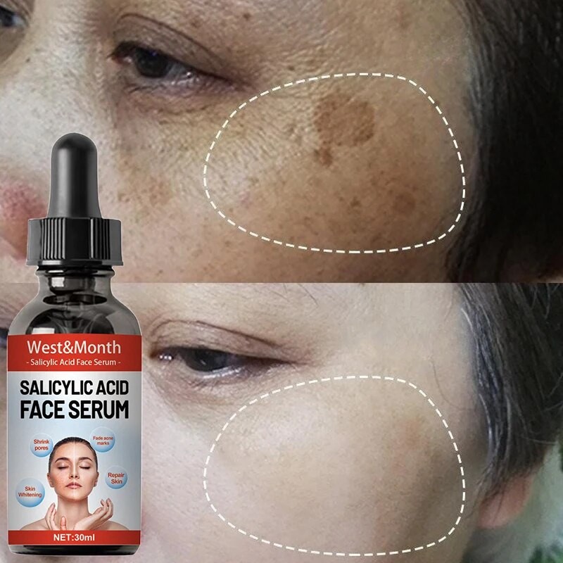 Nicotinamide Whitening Freckle Face Serum Remove Melasma Dark Spots Salicylic Acid Pore Shrink Fade Acne Marks Skin Care Product
