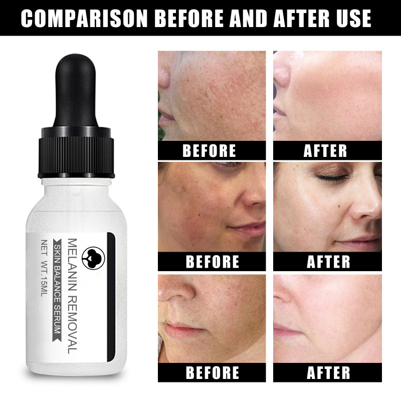 Niacinamide Whitening Freckle Serum Removal Melasma Dark Spots Pigment Melanin Anti-Aging Correcting Brighten Essence Skin Care