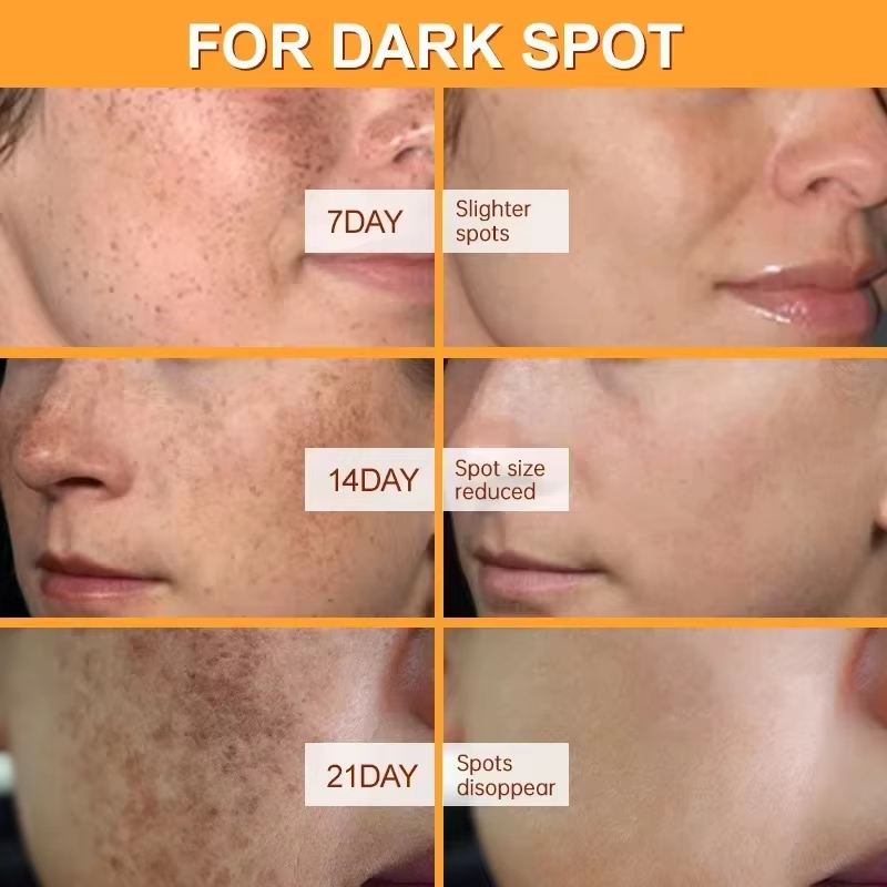 Effective Whitening Freckles Face Cream Dark Spot Corrector Remove Melasma Fade Melanin Pigmentation Brighten Skin Care Products
