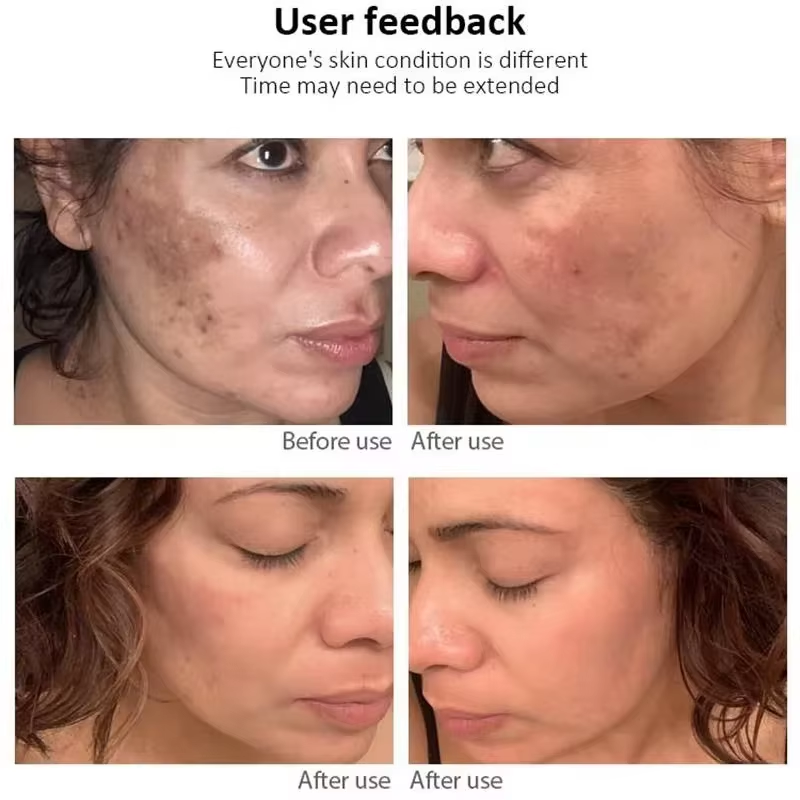Effective Whitening Freckles Face Cream Dark Spot Corrector Remove Melasma Fade Melanin Pigmentation Brighten Skin Care Products