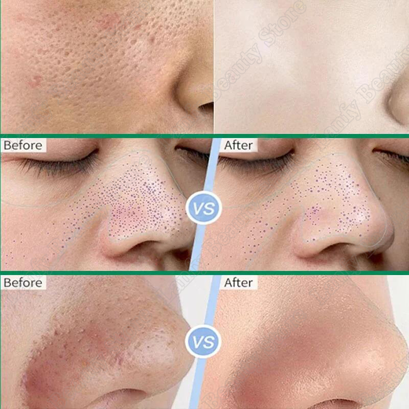 Salicylic Acid Pore Clearing Cream Shrink Pores Remove Blackheads Acne Brighten Moisturizing Smooth Skin Care Korean Products