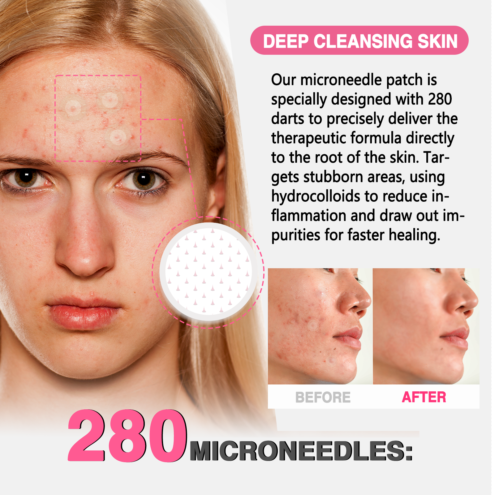 GROEI 18Pcs Microneedle Acne Patches Pimple Invisible Beauty Concealer Blemish Treatment Deep Clean Pores Overnight Recovery