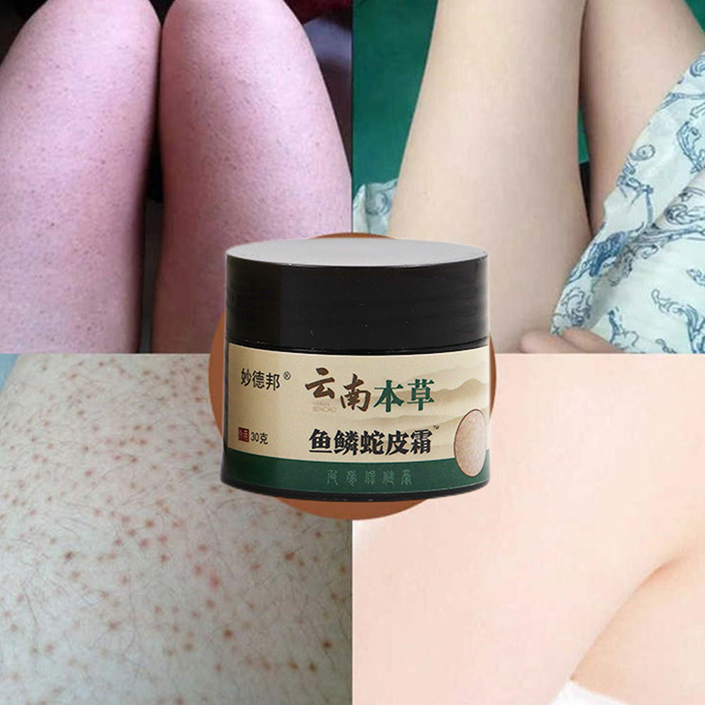 Chicken Skin Repair Cream Curing Keratosis Follicle Pilaris Body Dark Spot Remove Thick Pores Moisturizing Smooth Body Care 30g