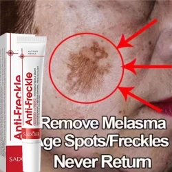 Effective Whitening Freckles Face Cream Dark Spot Corrector Remove Melasma Fade Melanin Pigmentation Brighten Skin Care Products